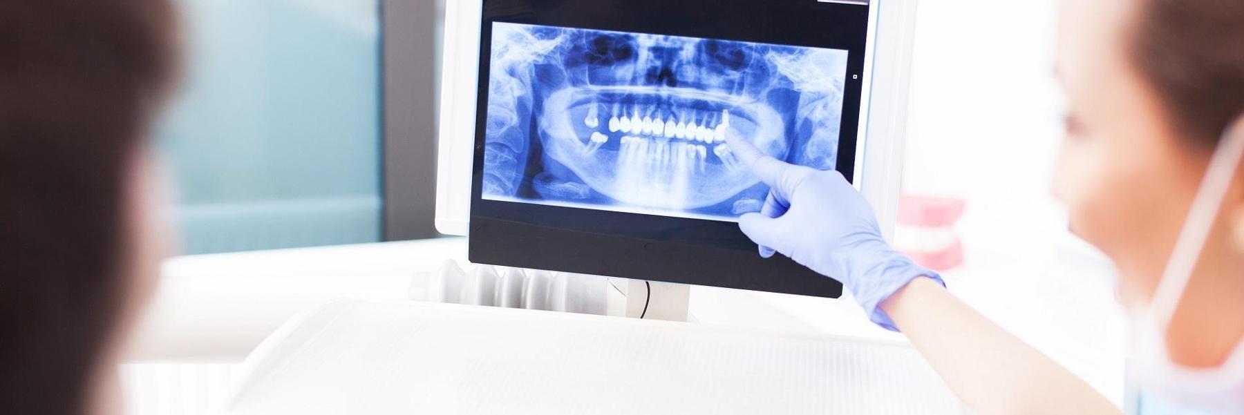 Tooth Extraction | Dentist